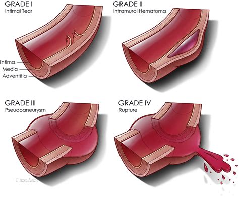 Injury Grade Is A Predictor Of Aortic Related Death Among Patients With
