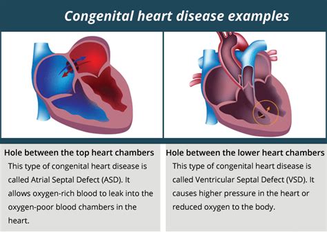 Understanding Congenital Heart Disease In Adults Causes Symptoms And