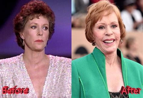 Carol Burnett Before And After Cosmetic Surgery Celebrity Plastic