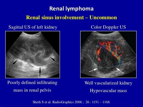 Renal Lymphoma Ultrasound