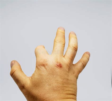 Hand Of A Person With A Part Of The Index Finger Missing Due To A Prior