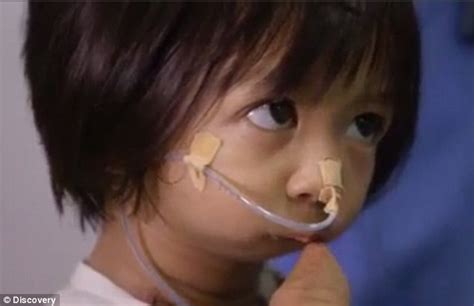 Filipino Girl Born With A Sealed Mouth Goes Under The Knife Daily