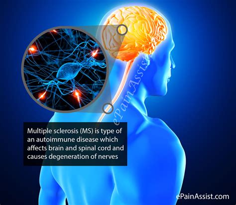 Multiple sclerosis is an autoimmune disease in which the immune system attacks and destroys the protective covering of nerve cells (myelin) of the brain, spinal cord, and/or eyes. Multiple Sclerosis or Disseminated Sclerosis|Types|Risk ...