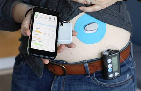 Nhs To Trial Artificial Pancreas For Patients With Type 1 Diabetes