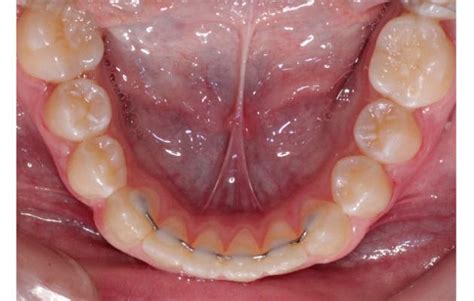 Quickbond Blr Bonded Lingual Retainer Accutech Orthodontic