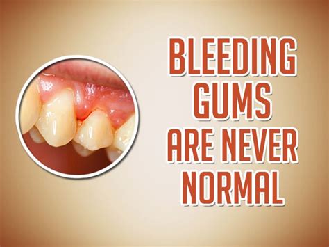 If Your Gums Bleed When You Brush It Could Be A Sign Of Gingivitis