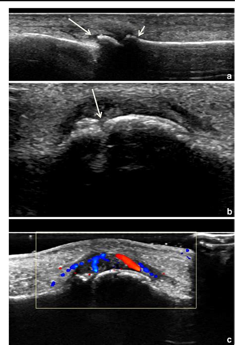 Mri And Ultrasound Of The Hands And Wrists In Rheumatoid Arthritis I