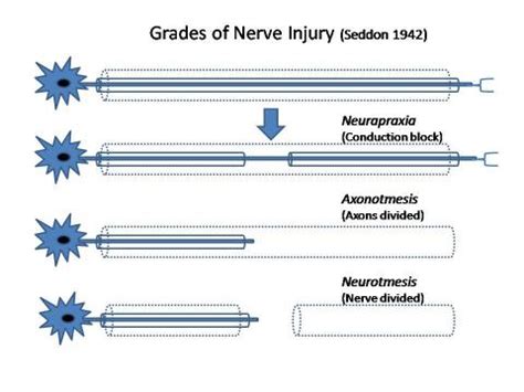 This type of nerve injury is caused by a crush or pressure damage. Classification of Peripheral Nerve Injury - Physiopedia