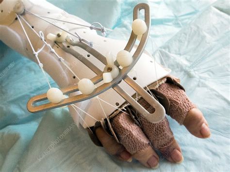 Hand Joint Replacement Stock Image C0300191 Science Photo Library