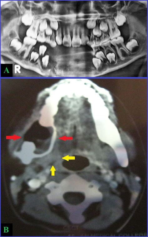 Eosinophilic Granuloma Of The Mandible A Diagnostic Dilemma Bmj Case