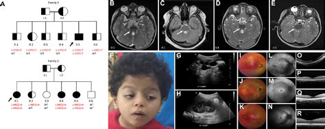 Figure 1 From Arl3 Mutations Cause Joubert Syndrome By Disrupting