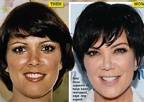 Kris Jenner Then And Now After Plastic Surgery Celebrity Plastic