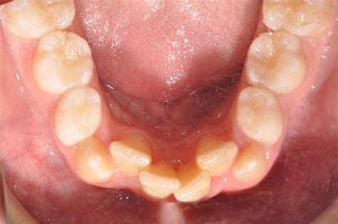 Common Teeth Problems Iowa City Orthodontics