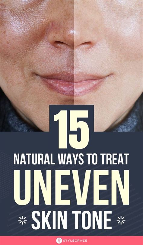 Uneven Skin Tone Tips To Get Rid Of It Naturally In 2020