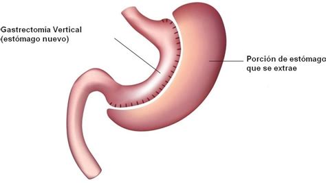 Gastrectomia Valencia Quir Rgica Hernia Centre