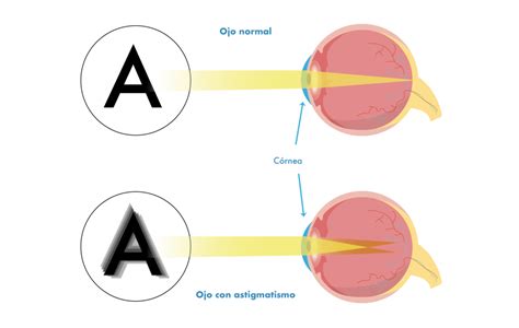 Tipos de astigmatismo Óptica Azpilicueta