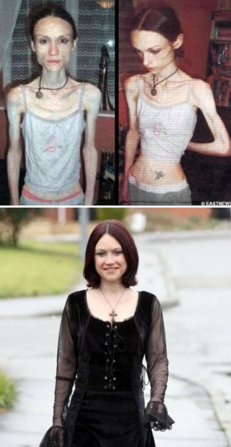 Some Of The Most Shocking Cases Of Anorexia Ever Seen Thatviralfeed