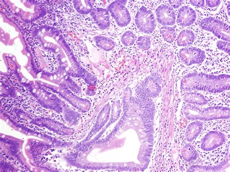 Pathology Outlines Peutz Jeghers Polyp