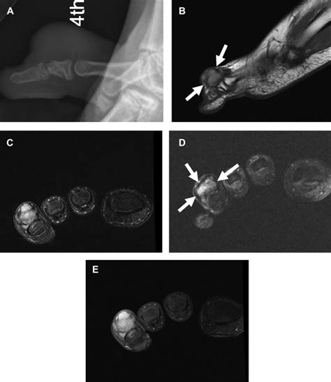 Mr Imaging Of Pediatric Musculoskeletal Tumors Radiology Key