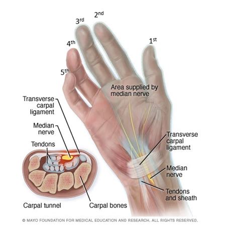 The Etiology Of Carpal Tunnel Syndrome Health Science Reviews