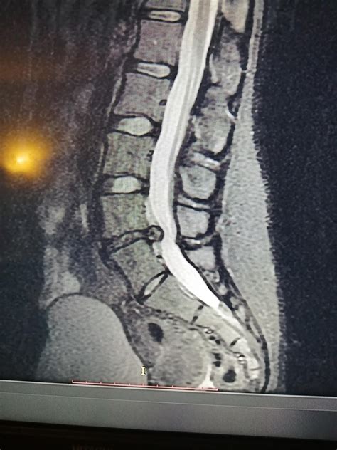 Spinal Disc Bulge Herniation Sherrod Chiropractic Plc Hot Sex Picture