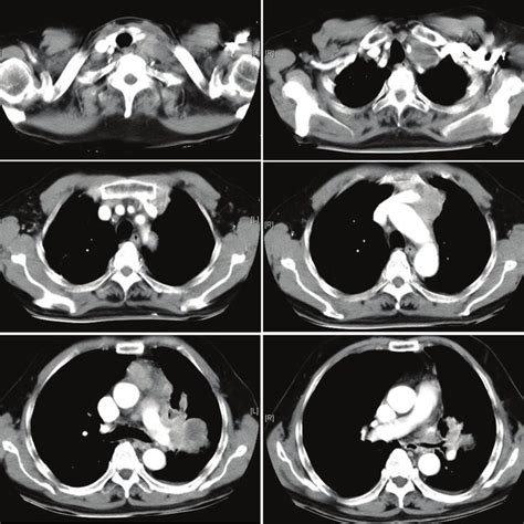 Chest Ct With Contrast Demonstrates A 45 Cm Soft Tissue Mass With