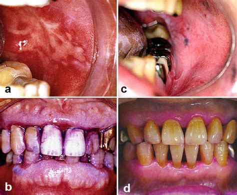 Oral And Dental Healthcare For Oral Cancer Patients Planning
