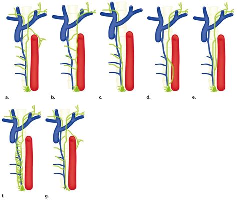 Figure 1 From Lymphatic Ir For Lymphatic Leakage Semantic Scholar