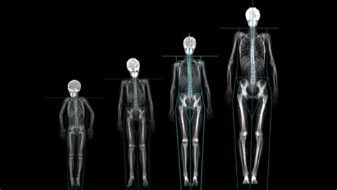 Dexa is today's established standard for measuring bone mineral density (bmd) which. Bone Mineral Density Assessment | Texas Back Institute