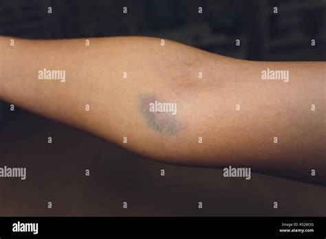 Bruise Arm High Resolution Stock Photography And Images Alamy