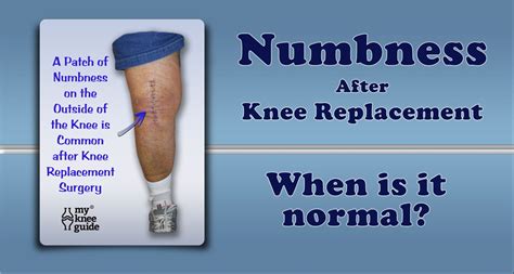 Knee Numbness A Common Post Operative Finding Knee Replacement Knee Replacement Surgery