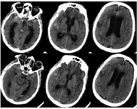 Upper Images Obstructive Hydrocephalus With Dilated An Open I