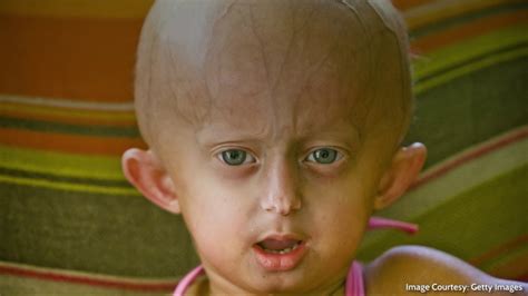 The Rare Disease Progeria Is Now Curable Youtube
