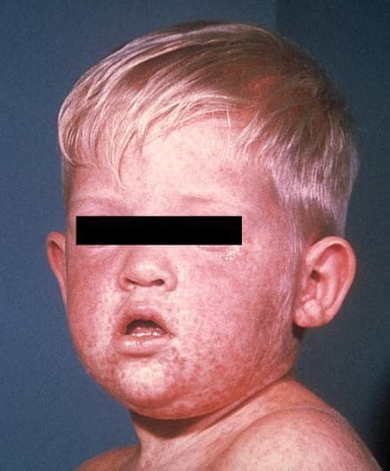For Healthcare Professionals Diagnosing And Treating Measles Cdc