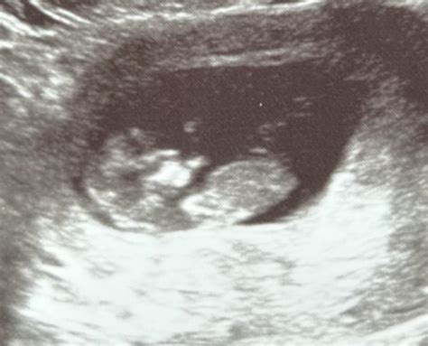 12 Week Ultrasound Any Guesses R Nubtheory
