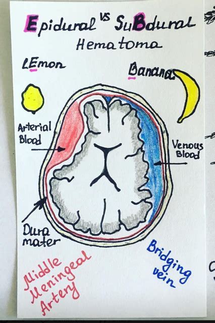 Symptoms of subdural hematomas are extremely variable. Pin by Vicki Ottley on Anatomy | Nursing school studying ...