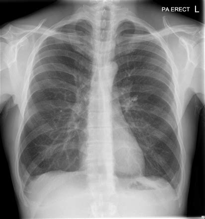 Diaphragmatic Slips Radiology Reference Article Radiopaedia Org