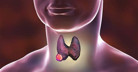 Thyroid Cancer Lumps In The Neck Jawline And Ear Lobes Justinboey
