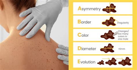 Patients can enter clinical trials before, during, or after starting their. SKIN CANCER BY GLENN KOLANSKY, M. D. | The Source