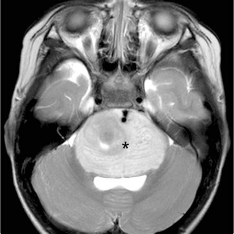 An Infiltrative Mass Lesion Causing Bilateral Sixth Nerve Palsy
