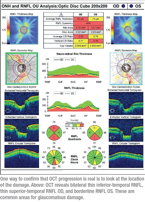 Glaucoma When Visual Fields And Oct Disagree