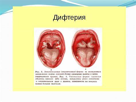 Эпидемический паротит диета ребенку Детские инфекции. Дифтерия, коклюш, эпидемический паротит - online Детские инфекции. Дифтерия, коклюш, эпидемический паротит - online Эпидемический паротит диета ребенку