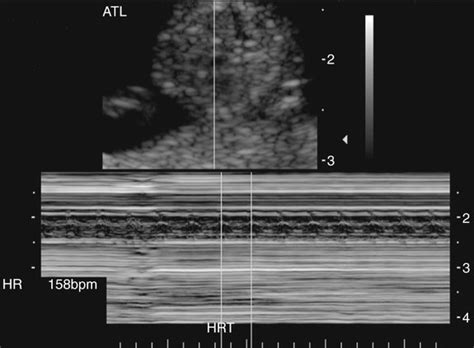 First Trimester Fetal Echocardiography Radiology Key