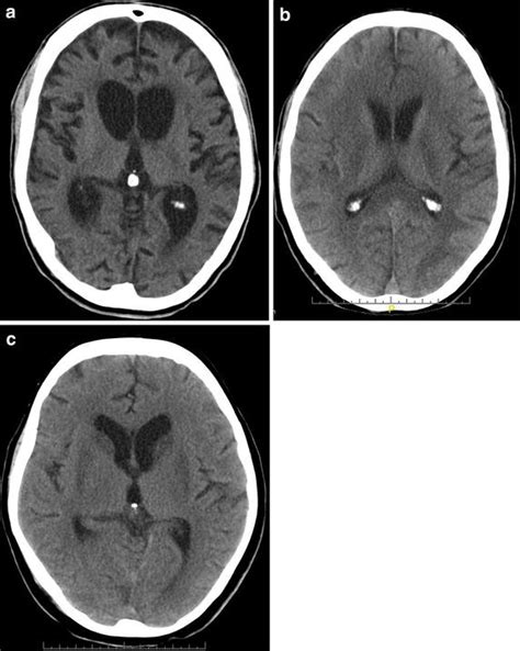 Typical Ct Scans Of Hypoxic Brain Damage Patients A Brain Atrophy And