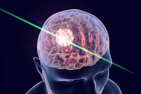 Quantum Signaling A Revolutionary New Treatment For Brain Tumors