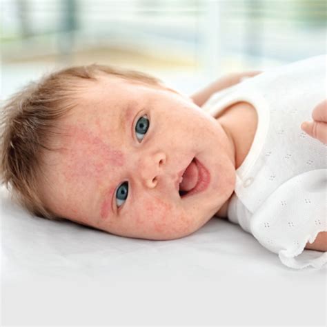 حساسیت نوزاد به شیر شرکت خدماتی شکوفایی