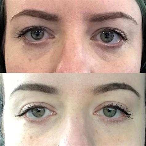 The Botox Brow Lift Explained Facial Injections Info Prices Photos