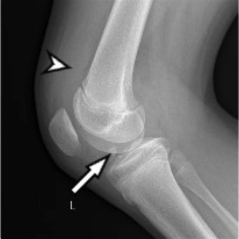 Mri Sagittal View Of The Left Knee Shows Marked Effusion Hematoma