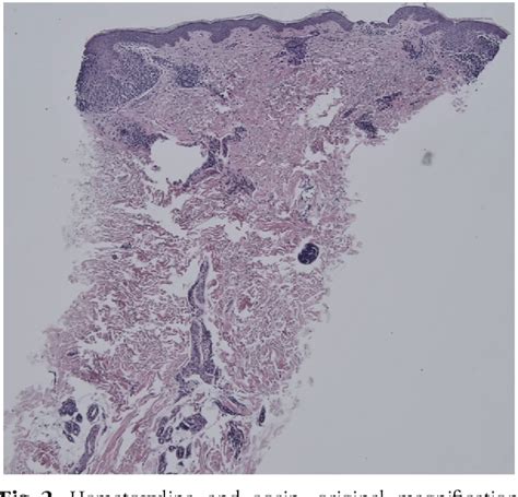 Figure 2 From Sarcoidal Granulomatous Reaction To Microneedling With