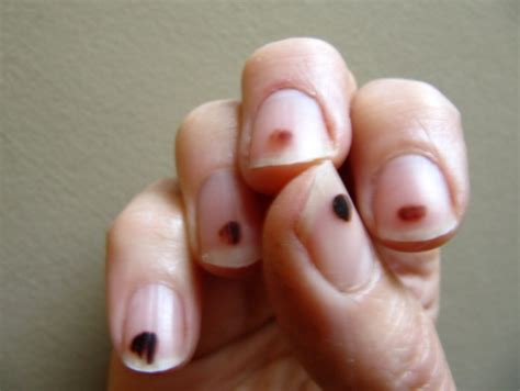 Black Spots On Nails Causes Under Fingernails Dots Tiny Lines On